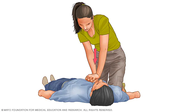 Cardiopulmonary resuscitation